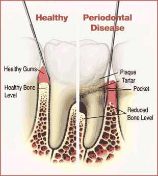 Animated illustration of pocket reduction dental procedure