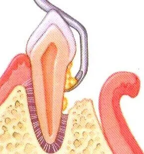 Step 3 of gum pocket reduction surgical procedure