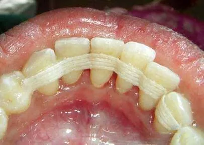 Teeth splinting procedure for non-surgical dental treatment