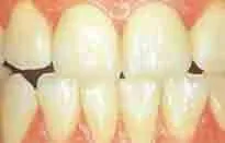 After indirect dental restoration treatment showing healthy teeth