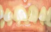 Before indirect dental restoration treatment at DentiCare India