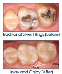 Close-up of customized dental inlay and onlay procedure