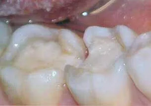 Pre-operative view for dental inlay and onlay treatment