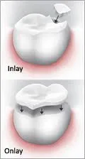 Overview of inlay and onlay dental restorations