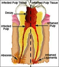 Direct and indirect pulp capping dental procedure illustration