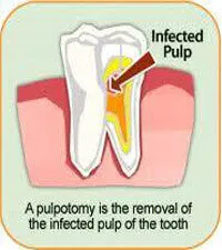 Pulpotomy dental treatment process for children and adults