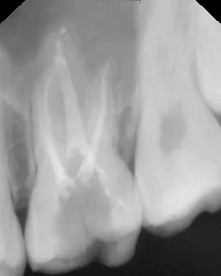 Diagram showing four root canals during multi-rooted root canal treatment