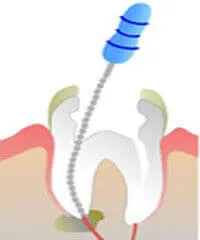 After successful laser-assisted root canal therapy treatment at DentiCare