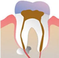 Before laser-assisted root canal therapy treatment at DentiCare