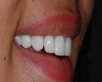 Indirect porcelain veneers application process at DentiCare India