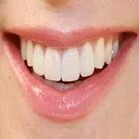 Ceramic Veneers - Denticare