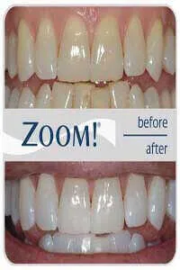 Zoom teeth whitening treatment session