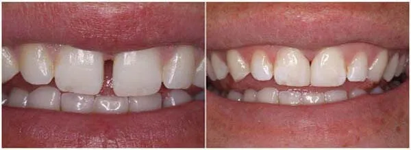Before and after diastema closure gap teeth treatment