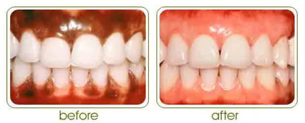Before and after results of laser depigmentation of gums
