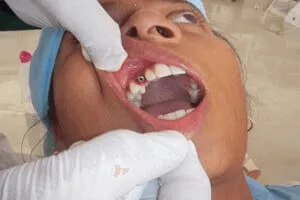 After successful dental implant exposure treatment result at DentiCare India