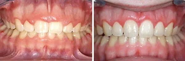 Gingivectomy gum contouring procedure at DentiCare India