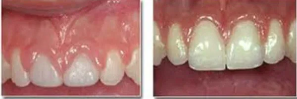 Professional gingivoplasty gum reshaping procedure at DentiCare India