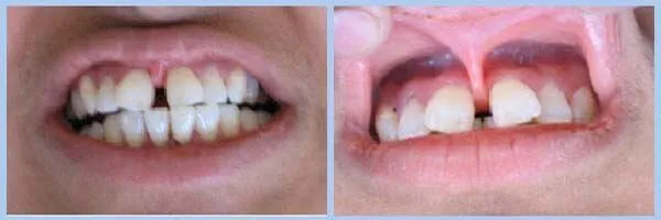 Professional frenectomy dental procedure at DentiCare India
