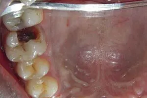 Oral polyp excision after successful treatment results