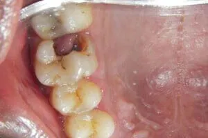 Oral polyp excision before treatment case