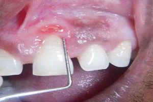 Pyogenic granuloma after successful treatment results