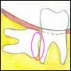 Disimpaction Horizontal - Denticare