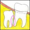 Vertical impacted wisdom tooth disimpaction treatment