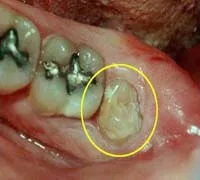 Wisdom teeth disimpaction procedure overview at Denticare India