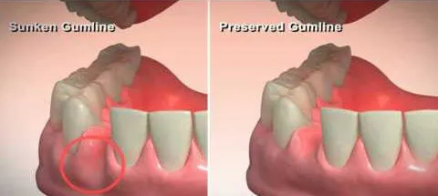 Surgical tooth extraction and socket preservation procedure at DentiCare India