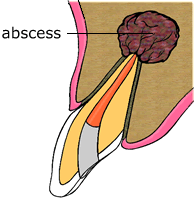 Step 1 animation showing root end surgery apicoectomy procedure