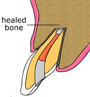 Step 4 animation showing final healing and suture placement after apicoectomy