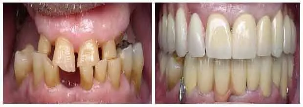 Full mouth rehabilitation procedure at DentiCare India