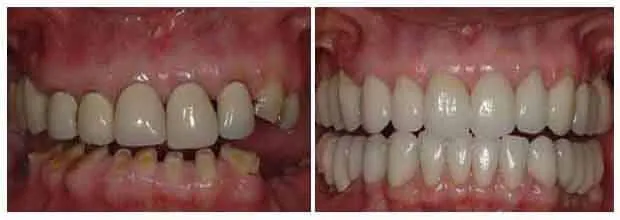 Patient undergoing full mouth rehabilitation treatment