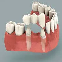 Dental Bridge Treatment - Denticare