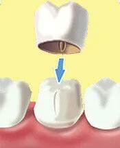 Dental Crown Procedure - Denticare