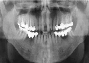 Crowns and Bridges After Treatment - Denticare