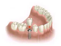 Single tooth dental implant procedure step 1 illustration