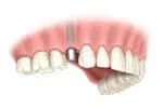 Single tooth dental implant abutment placement step 3