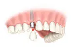 Single tooth implant final crown placement step 4