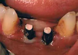 Pre-treatment view for 2 implant bridge at DentiCare India
