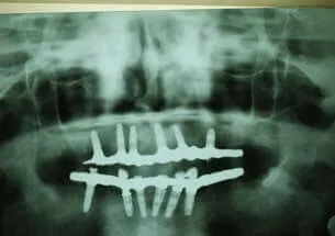 Hybrid denture option 2 for teeth replacement