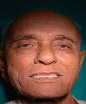 Happy patient smiling after hybrid denture implant procedure