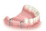 Step-by-step process of multiple teeth dental implants