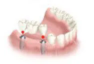 Advanced technology used for multiple teeth implants