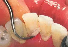 Hand scaling procedure performed by dentist at Denticare India