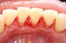 Clean teeth results after professional dental scaling treatment