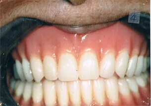 Implant Retained Dentures in Mouth - Denticare