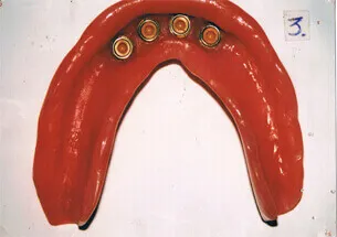 Lower Denture with Socket Attachments - Denticare