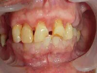 Drug Induced Abscess Flap Surgery Before After drug-induced abscess flap surgery recovery at DentiCare India