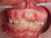 Drug Induced Abscess Flap Surgery Before Before drug-induced abscess flap surgery treatment at DentiCare India